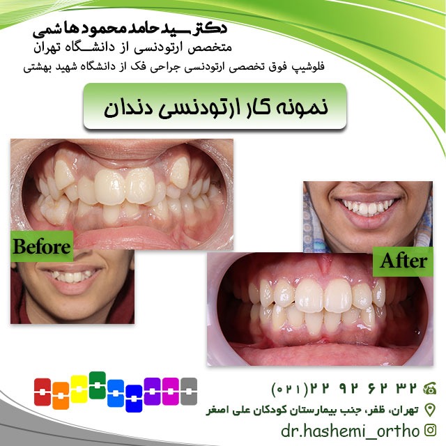 نمونه-کار-ارتودنسی-دندان