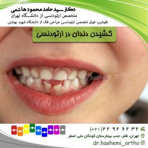 کشیدن-دندان-ارتودنسی